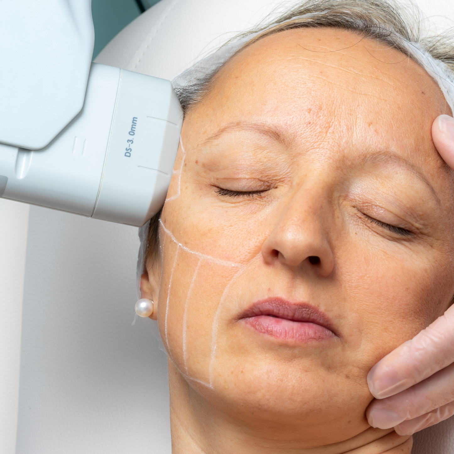 Formation combinée : Plasma froid et HIFU - "Lifting 12D"