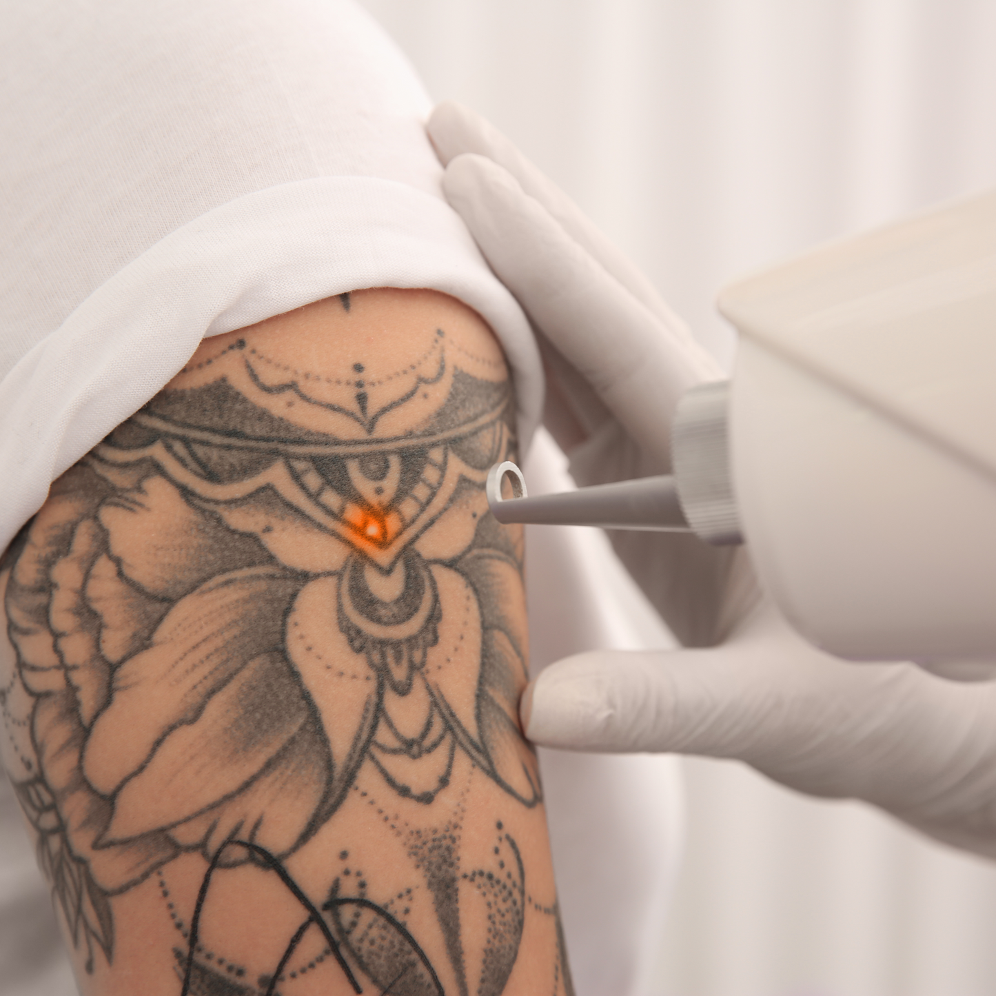 Détatouage au laser